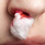 Erste Hilfe, Ursachen, Therapie, Vorbeugung. von Nasenbluten